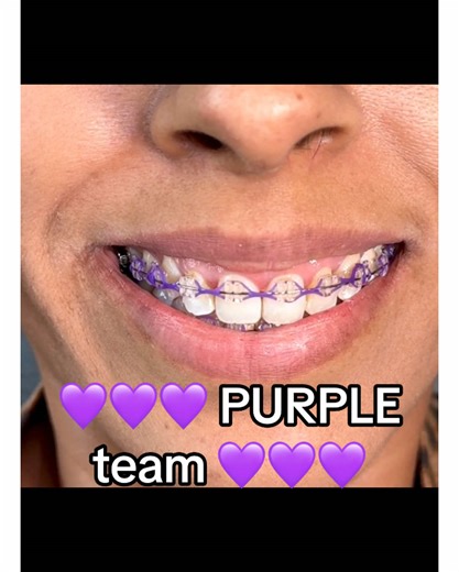 Descubre el color morado para tus brackets