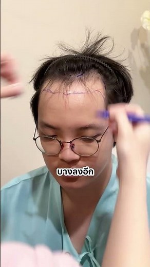 การประเมินเคสปลูกผม #ปลูกผมถาวร #ปลูกผม #FUE #hairsmithclinic