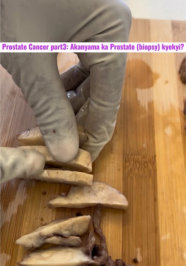 What is a prostate biopsy? ⚠️sensitive content: Viewer discretion is advised. #prostateseries #KebezaProject