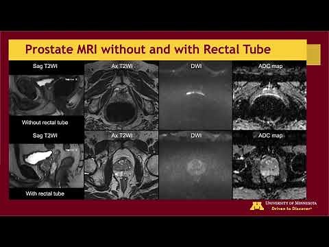Impact of 18 French Rectal Tube Placement on Image Quality of Multiparametric Prostate MRI