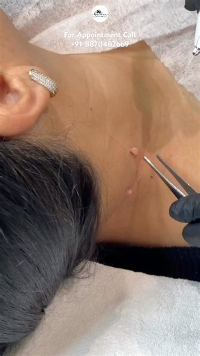Warts Skintags Removal Naturally #chennai #skincare #trending #wartstreatment #warts #skintags 🥰