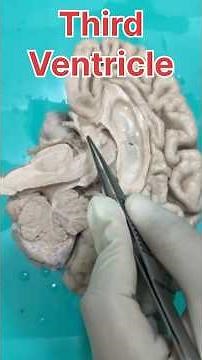 3rd ventricle of Brain: Boundaries in 60 seconds #anatomyshorts #anatomy