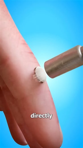 science_learning.point | Ever wondered how doctors remove warts using freezing techniques? Discover how liquid nitrogen helps destroy wart tissue and how your skin... | Instagram