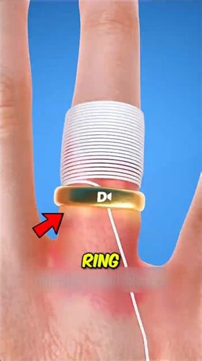 Why a Stuck Ring Can Be More Dangerous Than You Think