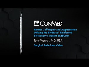 Rotator Cuff Augmentation Using the BioBrace® Reinforced Bioinductive Implant - Tony Wanich, MD