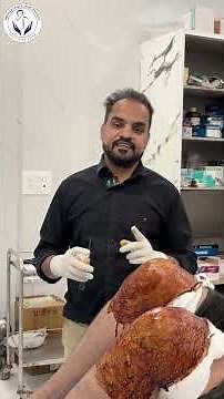 PRP Therapy for ACL Injury | Grade 1 ACL Sprain Knee Pain Treatment