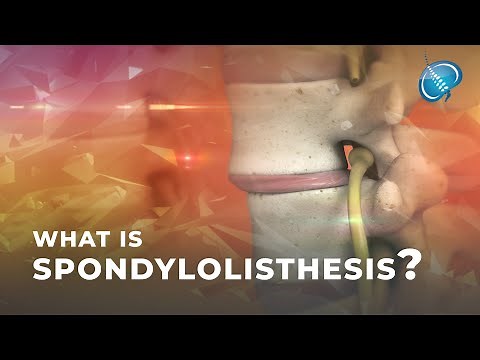 What is Spondylolisthesis? | Vertebral Slippage