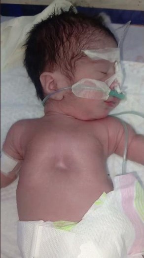 📌 Clap & Lift Technique for Babies | Chest Physiotherapy