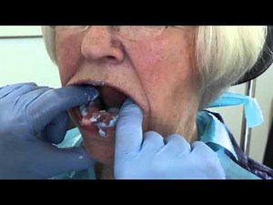 Removable partial denture definitive mandibular impression