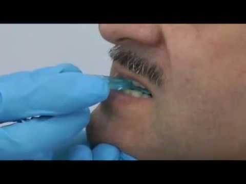 サイレンサーSLゲージの使用方法（ポジショニング用バイトの採得）