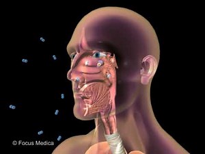Acute exacerbation of chronic bronchitis