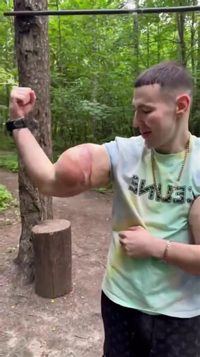 Enhancing Muscle Growth with Synthol: The Ultimate Bodybuilding Guide