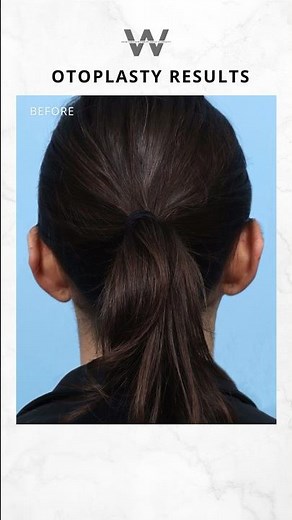 Before and after results: Otoplasty ear pinning procedure for prominent ears - by Dr. Jeffrey Wise