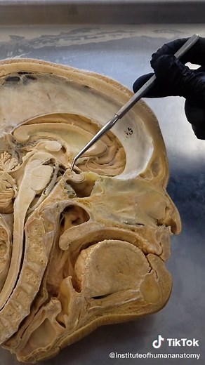 Understanding Sinus Cadaver and Sphenoidal Sinusitis