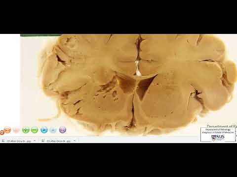 Cerebral infarct: Gross Pathology
