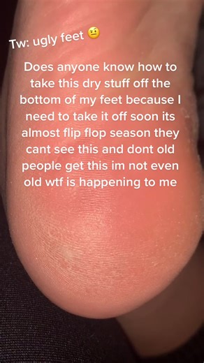 Yes its on the bottom of my feet, now help please #DADMOVES #PerfectAsWeAre #intothethickofit #ecofriendly #blackmusic #bald #buffering #dryfeet #help