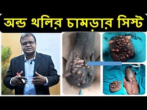 অন্ড থলির চামড়ার সিস্ট - Sebaceous cyst on scrotum - অন্ড থলির গুটিকা সিস্ট Dr A Mannan