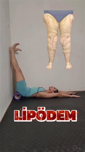 Lipödem sorunu yaşayanlar dikkat