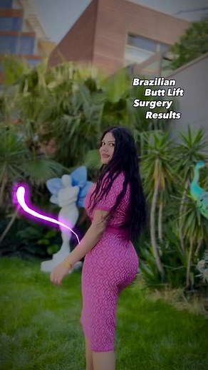 BBL Surgery Results Update - 5 Months Later