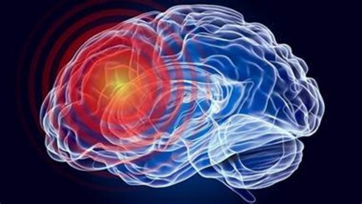 The impact of stroke on speech comprehension