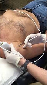 Shoulder Subacromial Injection - Elite Sports Medicine - Lethbridge