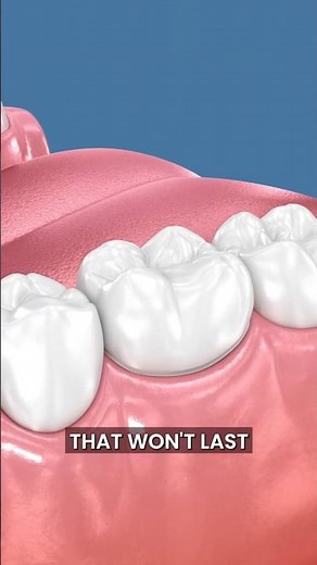 Reasons for Composite Dental Bonding Failure - And How We Do It Right