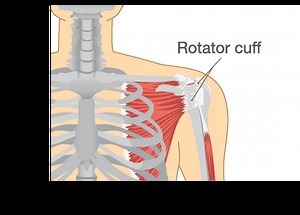 Shoulder Impingement Surgery - AOA Orthopedic Specialists