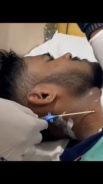 Central Line Removal | How to remove Central line | Internal Jugular vein removal #hospital #doctor