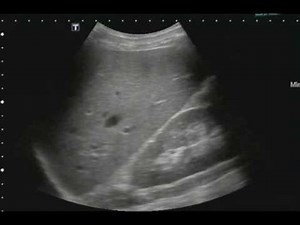 FAST Exam Normal Morrison's Pouch JETem 2016