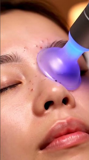 ASMR Dermatology: Glabella Blackhead Suction (Between Eyebrows Pores, Visible Plugs, No Talking)