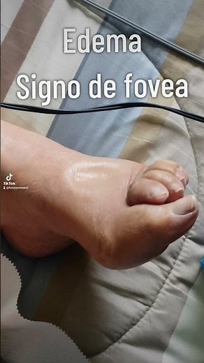 edema signo de fovea o godete #fisioterapia
