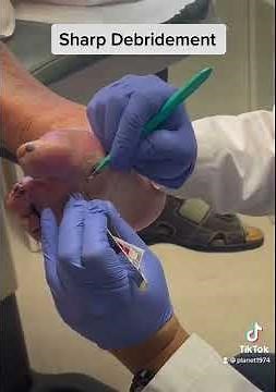 Sharp Debridement (bedside)