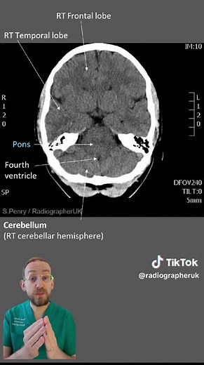 Exploring Brain Anatomy: CT Scan Insights