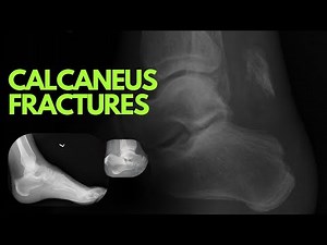Calcaneus Fractures