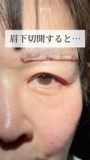 【眉下切開】眉下切開をすると… #shorts