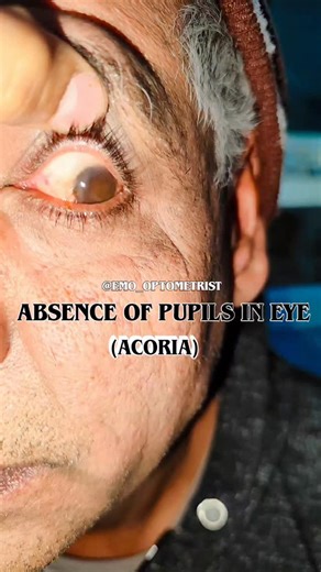 Eyes specialist 😊ASP on Instagram: "Acoria (also spelled acorea) is the medical term for the complete absence of a pupil. The iris tissue covers the area where the pupil should be, so light cannot enter the eye. It is an extremely rare condition, usually present from birth, though it can also be acquired after trauma, inflammation, or disease. 😊✨😊 - *Congenital vs. acquired:* Most cases are congenital, but injury or ocular disease can also eliminate the pupil. - *Differentiation:* Acoria must