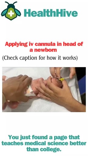 HealthHive on Instagram: "Applying an IV cannula to a newborn’s head is a delicate but sometimes necessary procedure when other IV sites (like hands or feet) are unavailable or unsafe. The scalp veins are often visible and accessible in infants, making them a viable option for urgent fluid or medication delivery. Why the head? · Newborns have prominent, superficial scalp veins. · It can be more stable and less prone to dislodgement than limbs. · Used when other sites are exhausted due to frequen