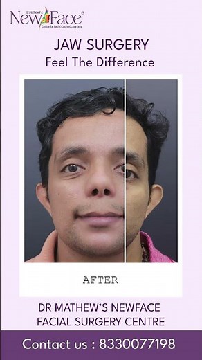Orthognathic Surgery Transformation | Jaw Alignment Result