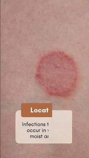 Fungal Infections by : How to Recognise the Signs on Your Skin and Nails