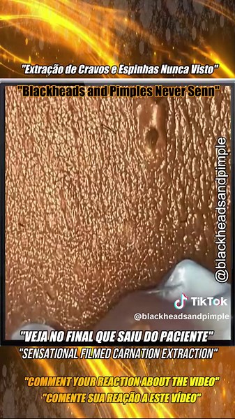squeezeblackhead no TikTok