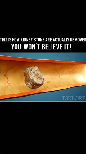 T3k Lore | Tech | Facts on Instagram: "“This Is How Kidney Stones Are Actually Removed — You Won’t Believe It!” 💧 Ever wondered how kidney stones are actually removed? Depending on their size and location, doctors use different methods to treat them. 🩺 Small stones often pass naturally by drinking plenty of fluids. 🔬 Larger stones may need advanced procedures such as: • Ureteroscopy (URS) • Retrograde Intrarenal Surgery (RIRS) • Percutaneous Nephrolithotomy (PCNL) 💥 Some are treated with Sho