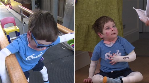 Butterfly boy walks after groundbreaking gene therapy