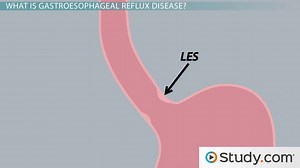 Specific Motility Disorders of the GI Tract - Video | Study.com