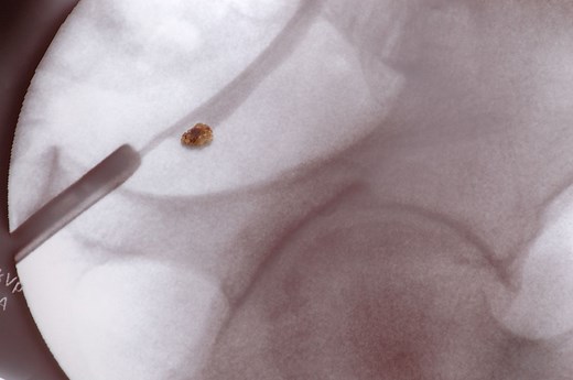 When and How Kidney Stones Are Surgically Removed
