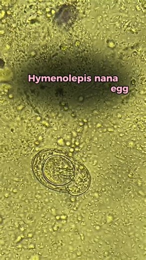 Zibeyda Gambarova | MD on Instagram: "🔬 Causal Agents Hymenolepiasis is caused by two species of cestodes: Hymenolepis nana (dwarf tapeworm, 15–40 mm) and Hymenolepis diminuta (rat tapeworm, 20–60 cm). H. diminuta usually parasitizes rodents and is rarely found in humans. Eggs of H. nana are immediately infective and survive in the environment for no more than 10 days. When ingested (with food, water, or via contaminated hands), the oncospheres are released, penetrate the intestinal villi, and