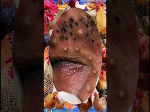 Blackheads Removal #252 | Acne Treatment and Very Satisfying Satisfying Pimple pop #blackheads