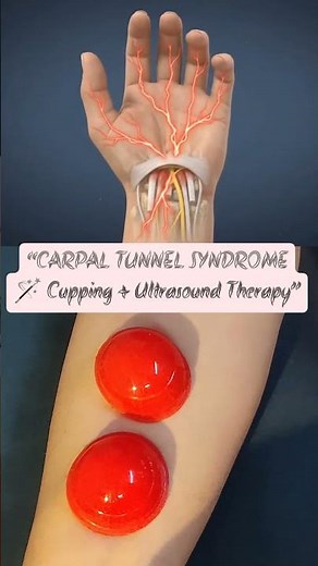 Numbness, tingling, or pain in your wrist and fingers?⚡Carpal Tunnel Syndrome—and how we treat it!