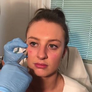 15 reactions · 5 comments | Tear trough correction with 1ml dermal filler. Instant results with no down time  #drtasscosmeticclinics #drtassskinclinics #antiwrinkleinjections #dermalfillers #cosmeticenhancement #noninvasive #plasticsurgery #cosmeticsurgery | Dr Tass Cosmetic & Skin Clinics | Facebook