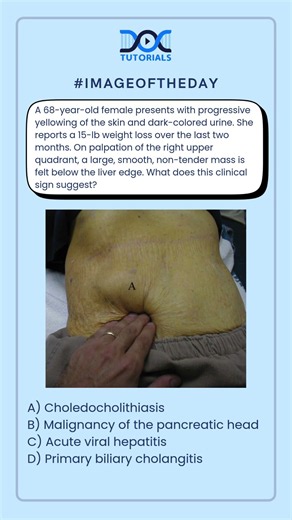 ⁣ What does this clinical sign suggest?
