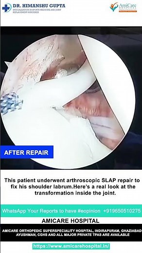 Arthroscopic SLAP Repair Success Story | 23-Year-Old Recovers Fully | Dr. Himanshu Gupta